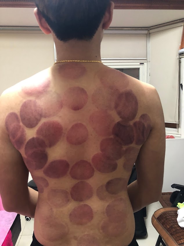 (請到新竹市香山店)正宗古法深層手技指壓 細膩深層油壓 無痛刮痧 拔罐 外出到府(自備按摩床)